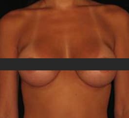Breast Augmentation Before Photo