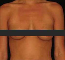 Breast Augmentation Before Photo