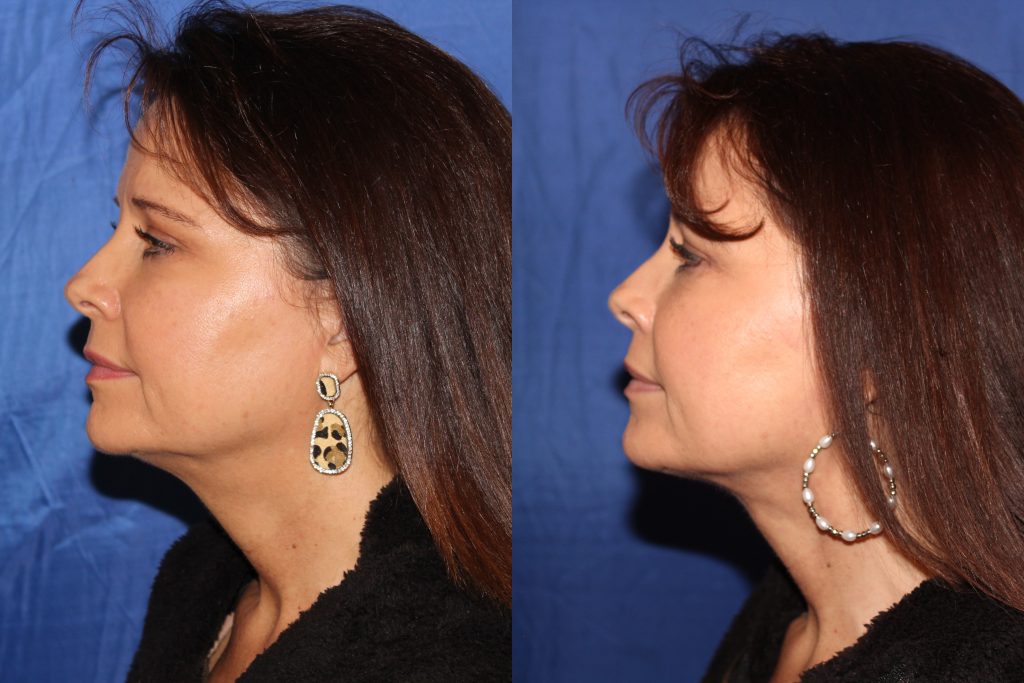 Profile of woman before and after lunch hour lift