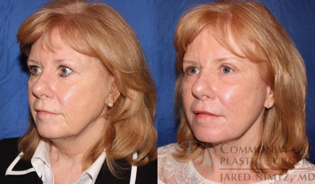 Slightly angled view of woman's face before and after eyelid surgery, a facelift, and fat transfer.