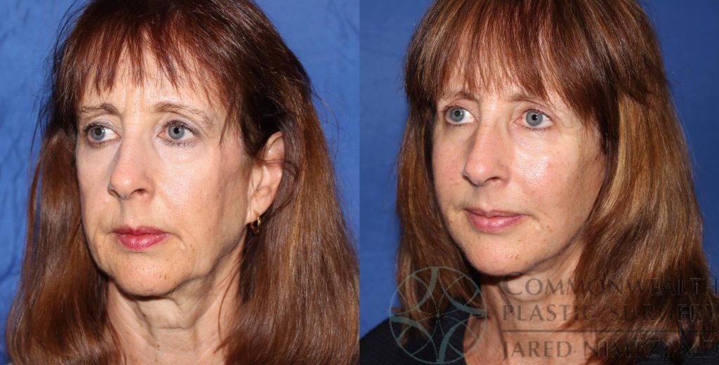 An oblique view of a woman before and after a facelift and facial fat transfer.