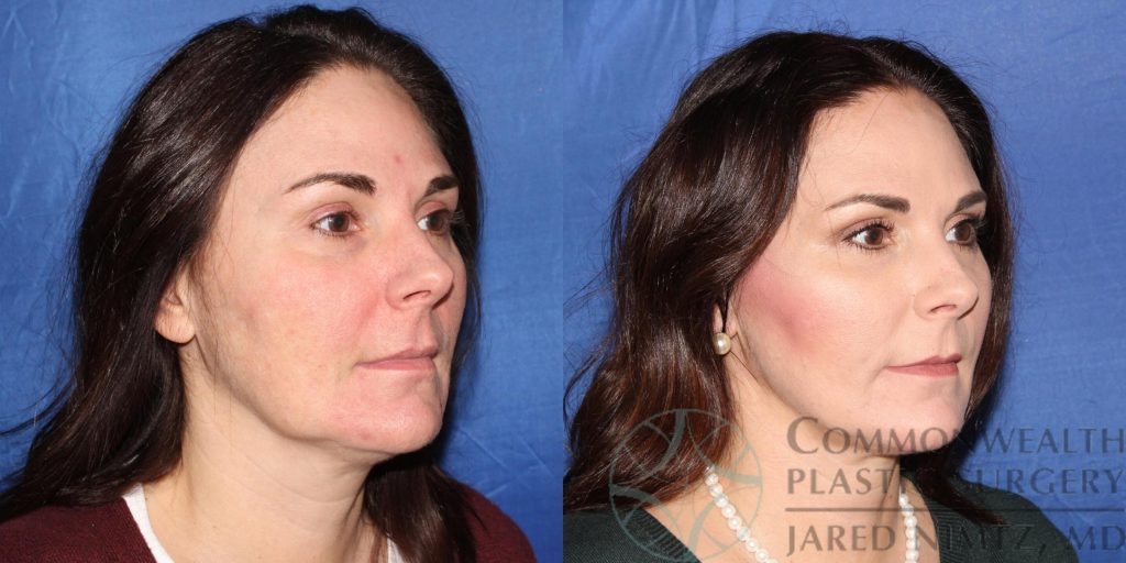 Oblique view of woman's face before and after facial fat grafting and a neck lift.