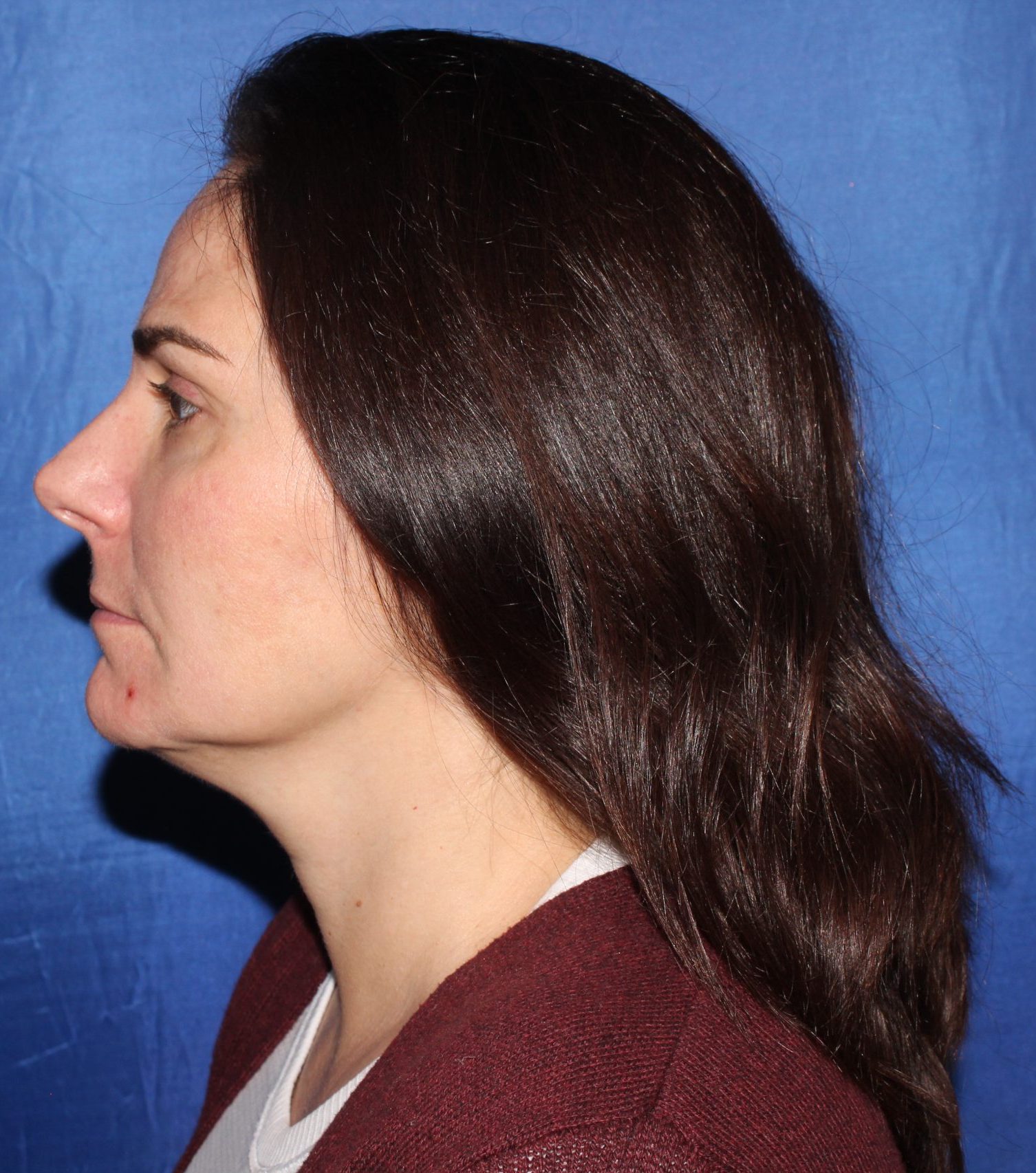 Before Facial Fat Grafting Profile