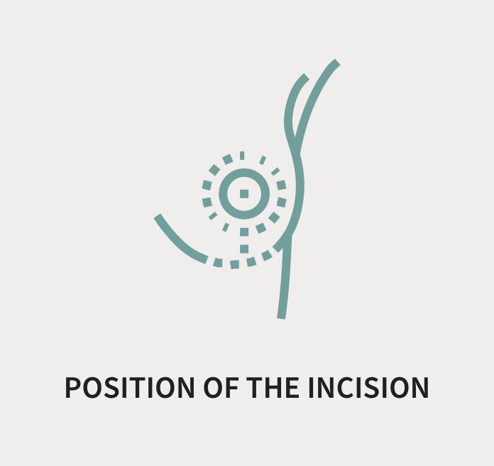 Position of the incision (graphic)